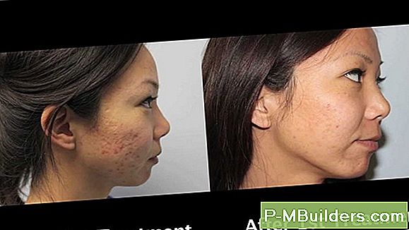Bad Resurfacing Basics